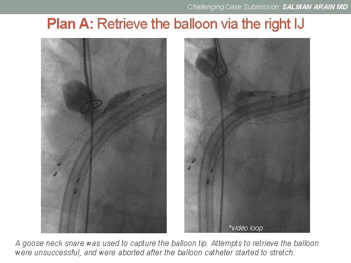 Challenging Case Submission: SALMAN ARAIN MD Plan A: Retrieve the balloon via the right