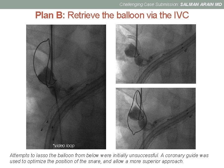 Challenging Case Submission: SALMAN ARAIN MD Plan B: Retrieve the balloon via the IVC
