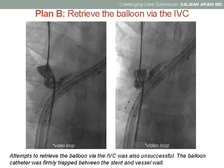 Challenging Case Submission: SALMAN ARAIN MD Plan B: Retrieve the balloon via the IVC