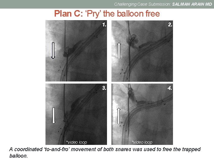 Challenging Case Submission: SALMAN ARAIN MD Plan C: ‘Pry’ the balloon free *video loop