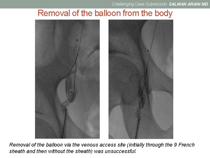 Challenging Case Submission: SALMAN ARAIN MD Removal of the balloon from the body 1.