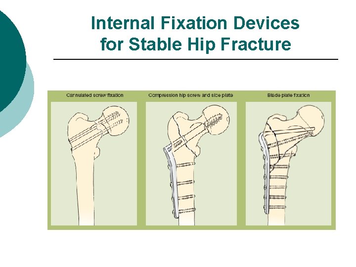 Internal Fixation Devices for Stable Hip Fracture 