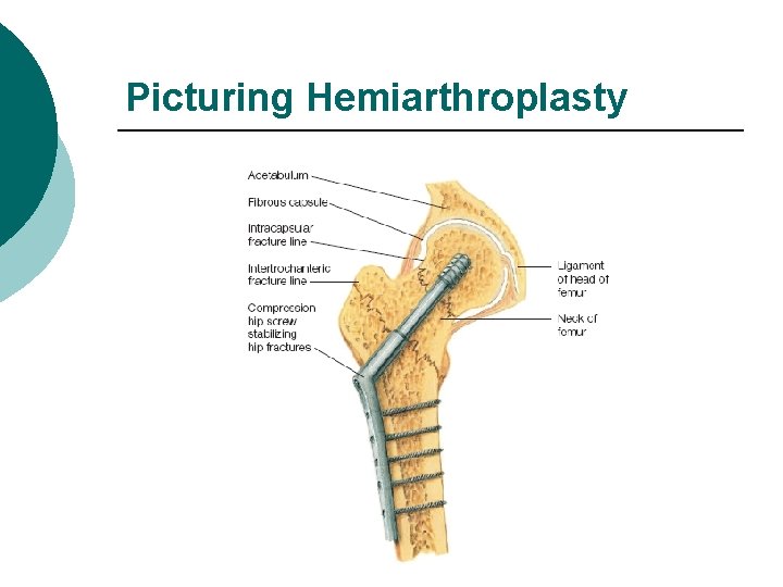 Picturing Hemiarthroplasty 