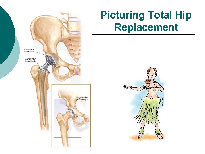 Picturing Total Hip Replacement 