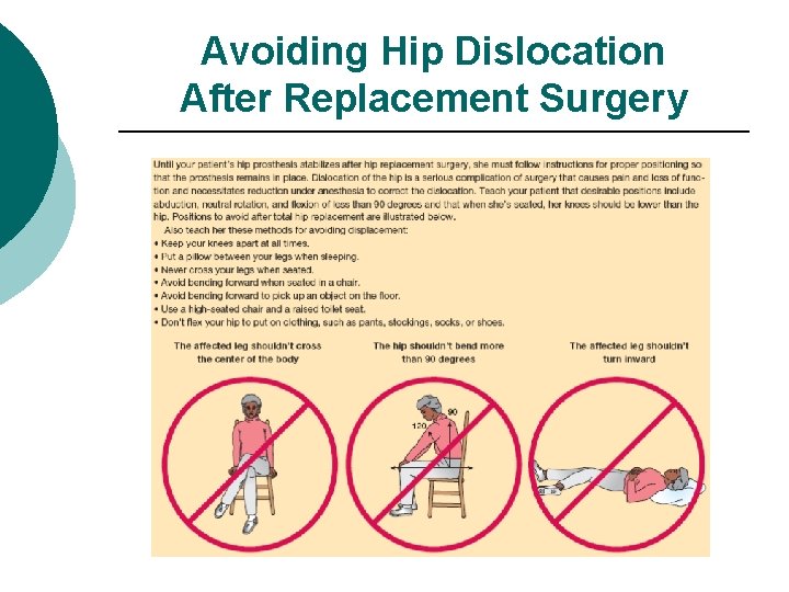 Avoiding Hip Dislocation After Replacement Surgery 