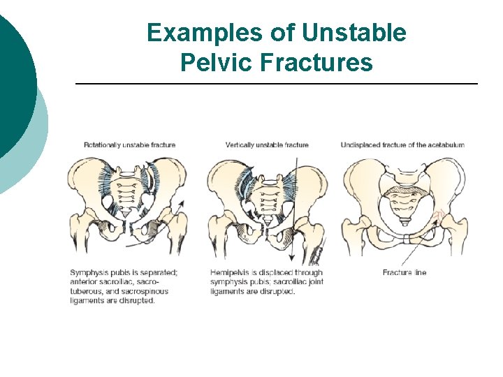 Examples of Unstable Pelvic Fractures 