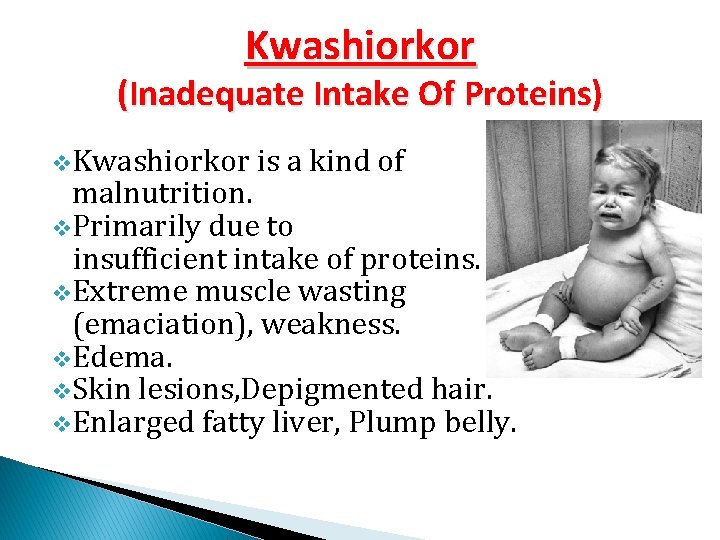 Kwashiorkor (Inadequate Intake Of Proteins) v. Kwashiorkor is a kind of malnutrition. v. Primarily