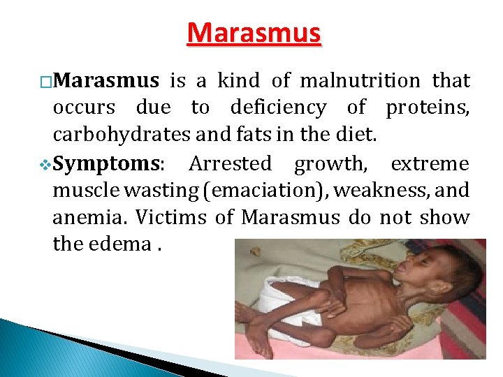 Marasmus �Marasmus is a kind of malnutrition that occurs due to deficiency of proteins,