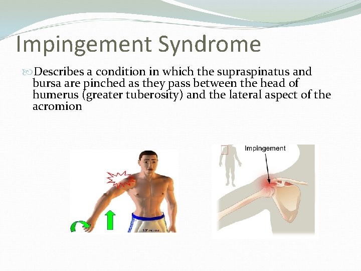 Impingement Syndrome Describes a condition in which the supraspinatus and bursa are pinched as