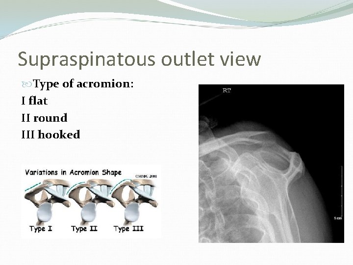 Supraspinatous outlet view Type of acromion: I flat II round III hooked 