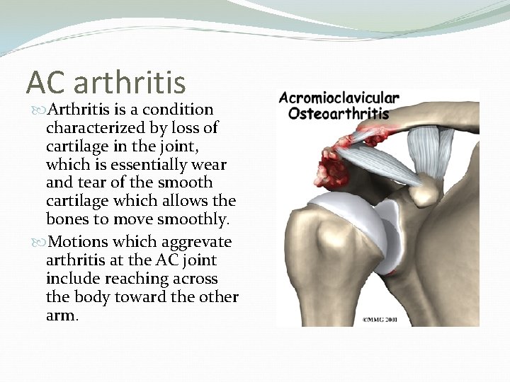 AC arthritis Arthritis is a condition characterized by loss of cartilage in the joint,