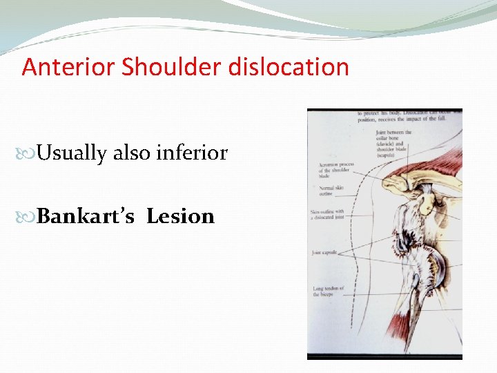 Anterior Shoulder dislocation Usually also inferior Bankart’s Lesion 