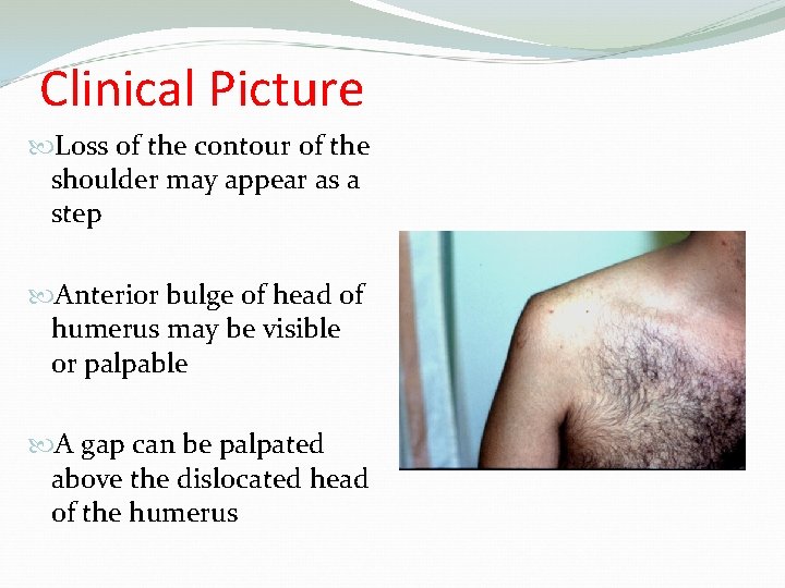 Clinical Picture Loss of the contour of the shoulder may appear as a step
