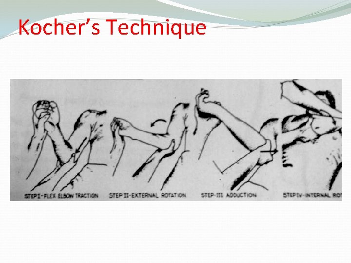 Kocher’s Technique 