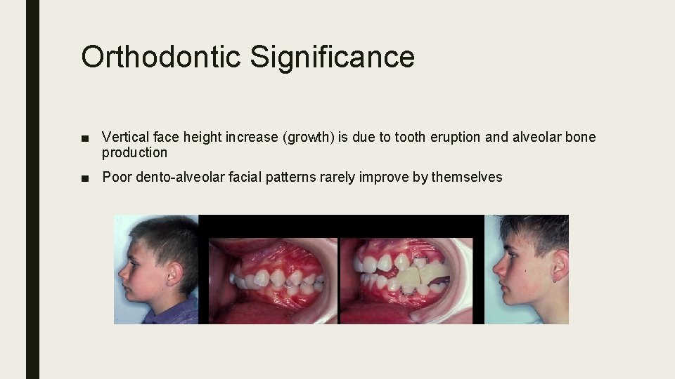 Orthodontic Significance ■ Vertical face height increase (growth) is due to tooth eruption and