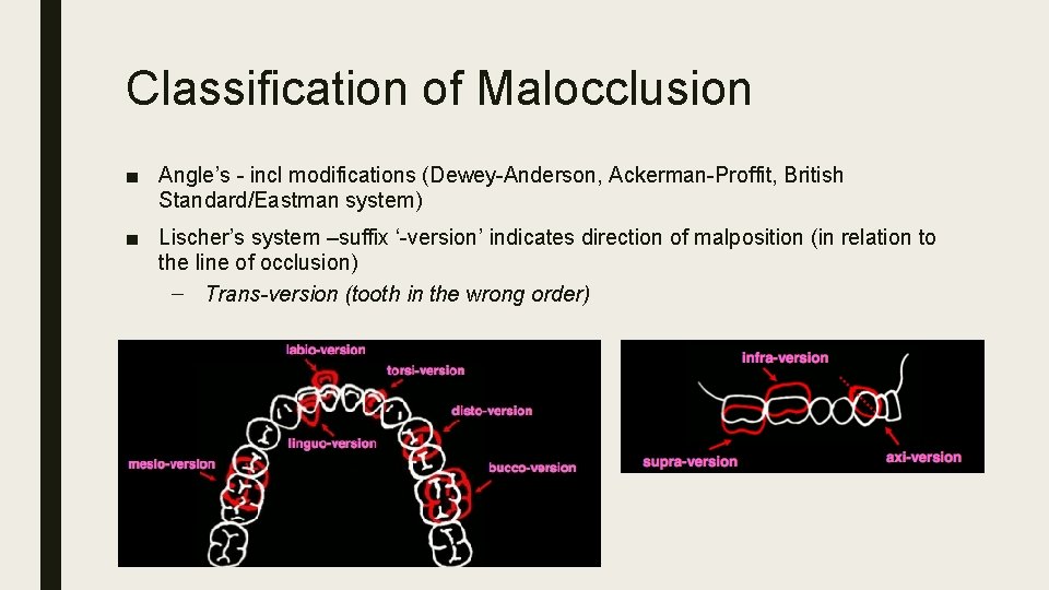 Classification of Malocclusion ■ Angle’s - incl modifications (Dewey-Anderson, Ackerman-Proffit, British Standard/Eastman system) ■