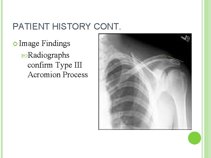 PATIENT HISTORY CONT. Image Findings Radiographs confirm Type III Acromion Process 