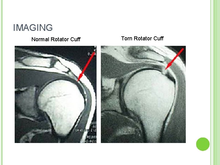 IMAGING Normal Rotator Cuff Torn Rotator Cuff 