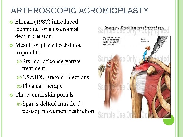 ARTHROSCOPIC ACROMIOPLASTY Ellman (1987) introduced technique for subacromial decompression Meant for pt’s who did