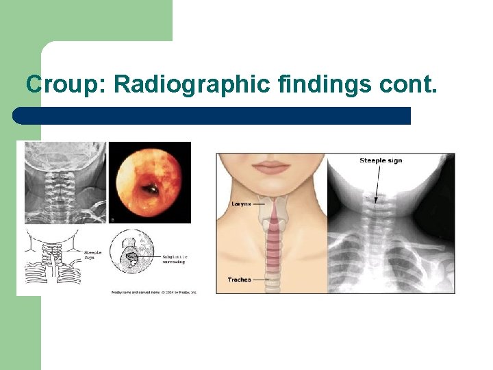 Croup: Radiographic findings cont. 