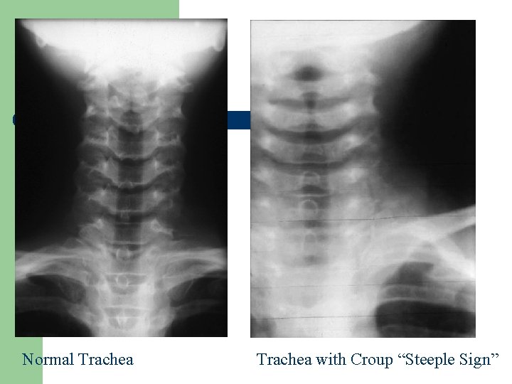 Normal Trachea with Croup “Steeple Sign” 