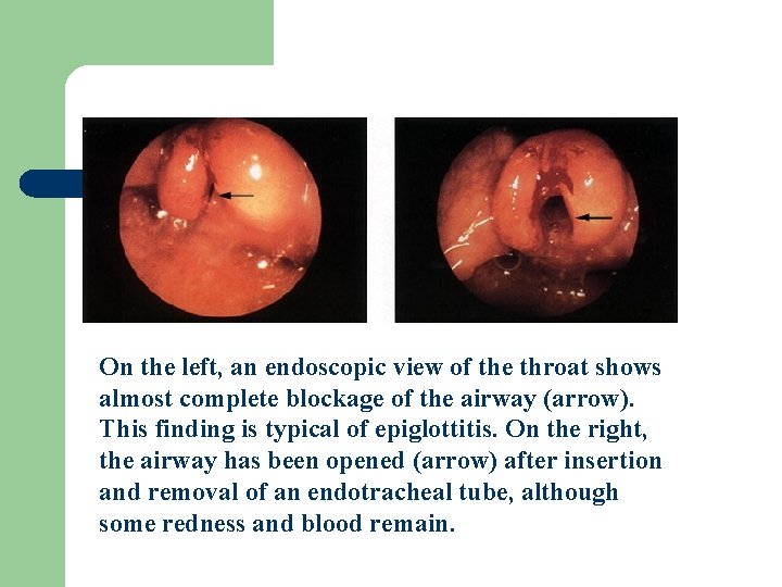 On the left, an endoscopic view of the throat shows almost complete blockage of