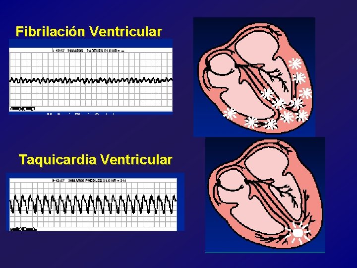 Fibrilación Ventricular Taquicardia Ventricular 