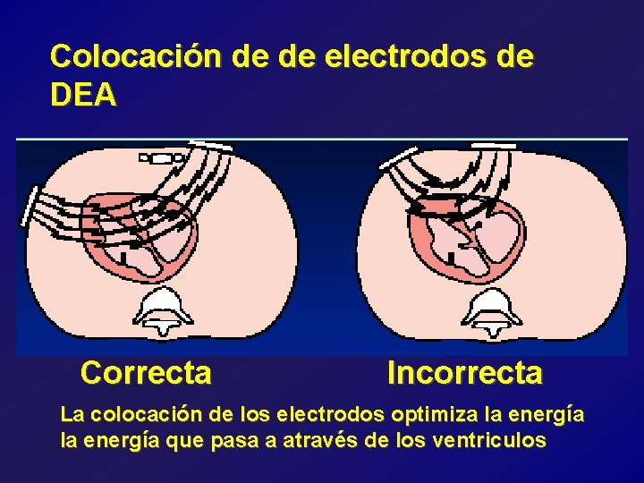 Colocación de de electrodos de DEA Correcta Incorrecta La colocación de los electrodos optimiza