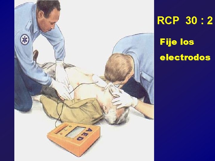 RCP 30 : 2 Fije los electrodos 