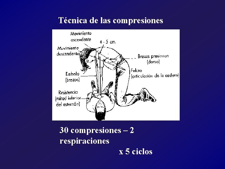 Técnica de las compresiones 30 compresiones – 2 respiraciones x 5 ciclos 