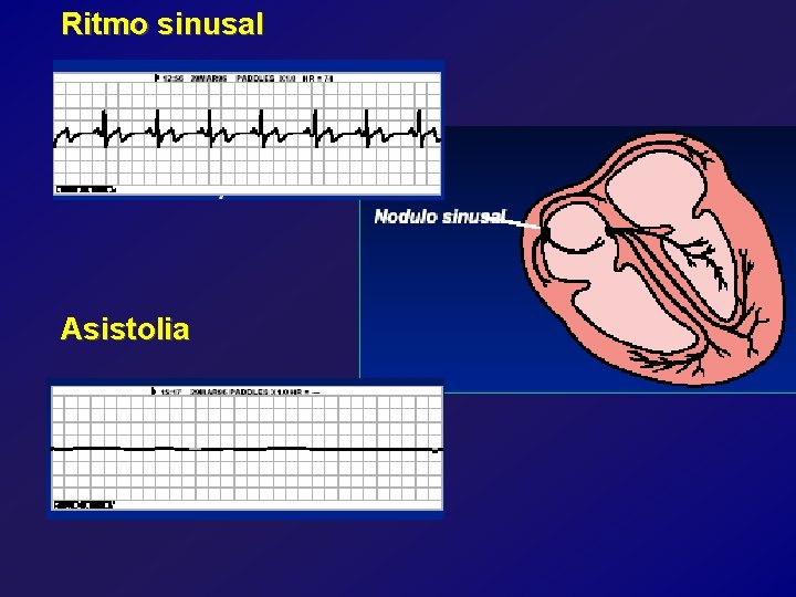 Ritmo sinusal Asistolia 