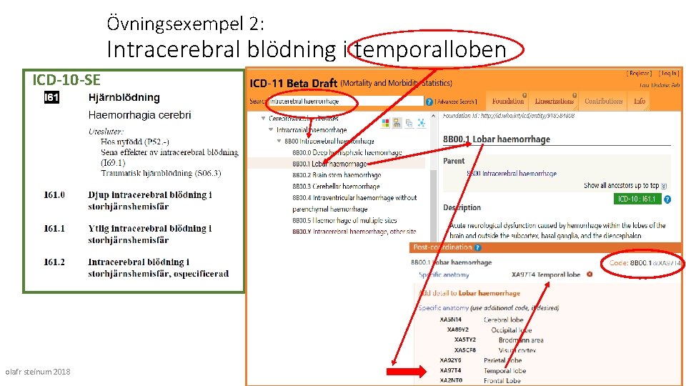 Övningsexempel 2: Intracerebral blödning i temporalloben ICD-10 -SE olafr steinum 2018 50 