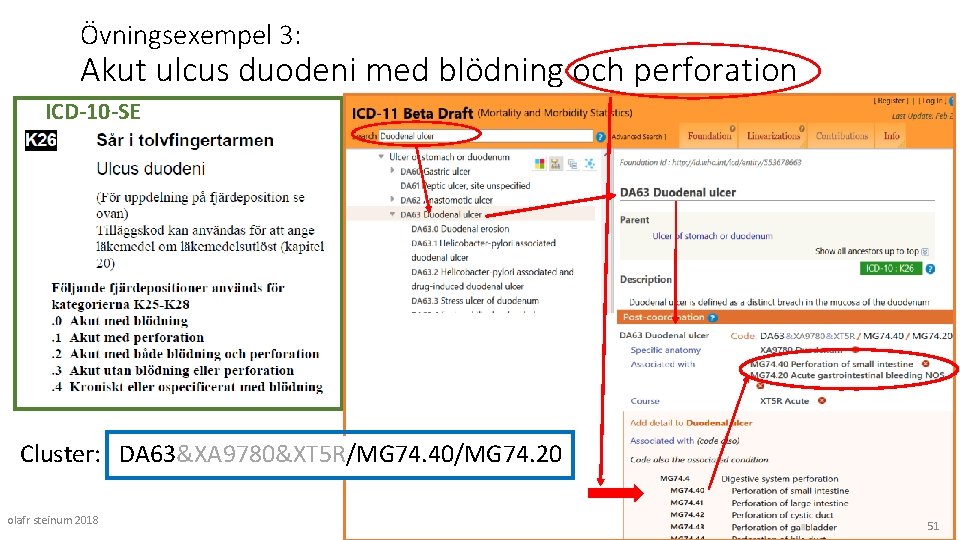 Övningsexempel 3: Akut ulcus duodeni med blödning och perforation ICD-10 -SE Cluster: DA 63&XA
