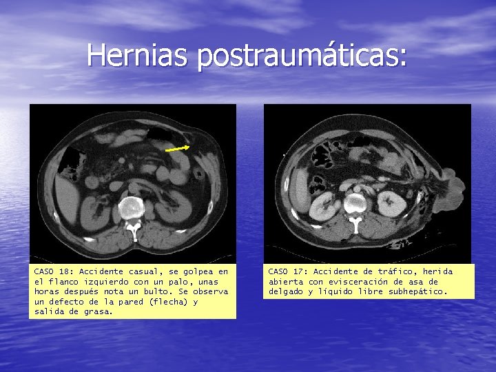 Hernias postraumáticas: CASO 18: Accidente casual, se golpea en el flanco izquierdo con un