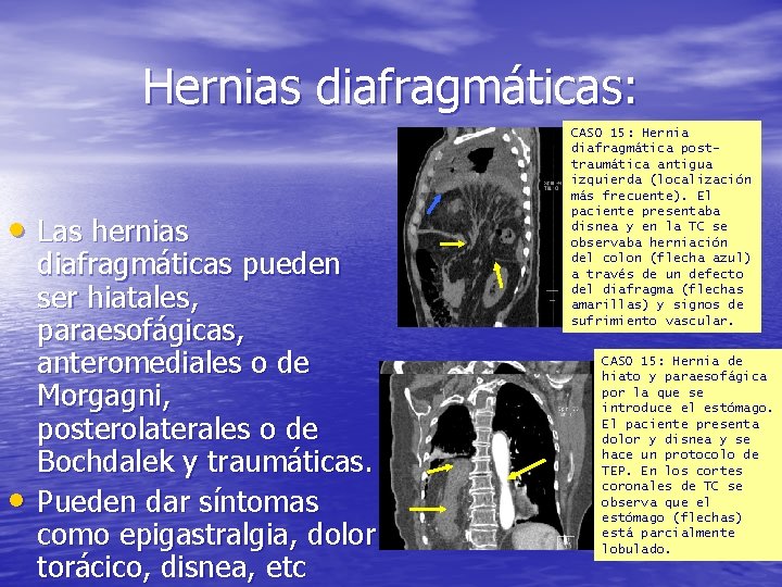 Hernias diafragmáticas: • Las hernias • diafragmáticas pueden ser hiatales, paraesofágicas, anteromediales o de