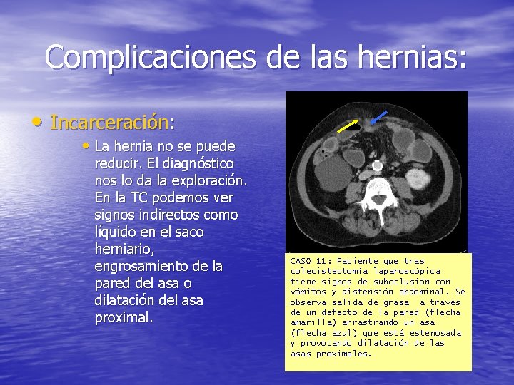 Complicaciones de las hernias: • Incarceración: • La hernia no se puede reducir. El