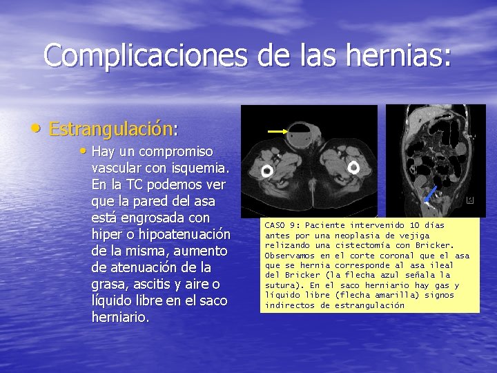 Complicaciones de las hernias: • Estrangulación: • Hay un compromiso vascular con isquemia. En
