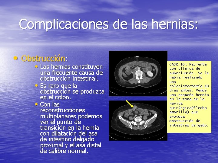 Complicaciones de las hernias: • Obstrucción: • Las hernias constituyen una frecuente causa de