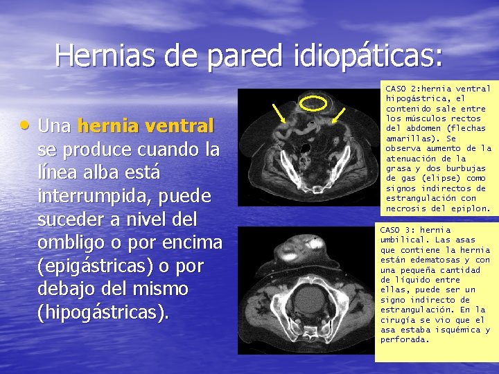 Hernias de pared idiopáticas: • Una hernia ventral se produce cuando la línea alba