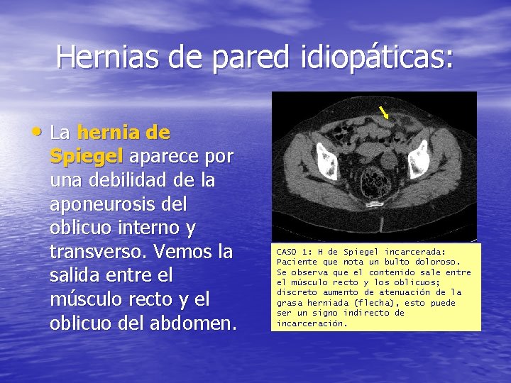 Hernias de pared idiopáticas: • La hernia de Spiegel aparece por una debilidad de