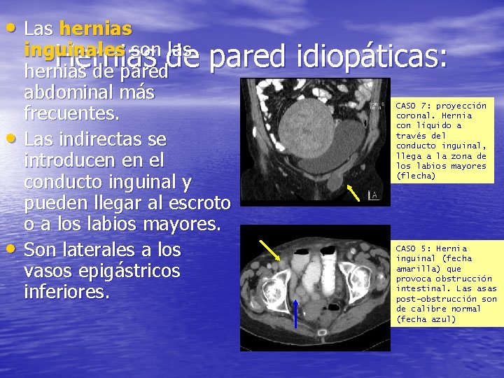  • Las hernias • • inguinales son las Hernias de pared idiopáticas: hernias