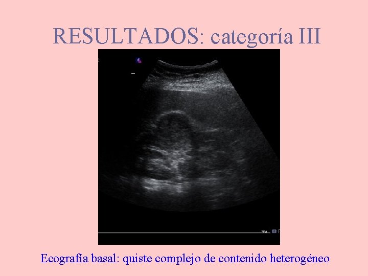 RESULTADOS: categoría III Ecografía basal: quiste complejo de contenido heterogéneo 