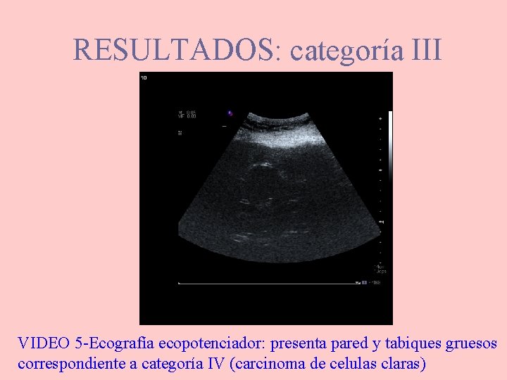 RESULTADOS: categoría III VIDEO 5 -Ecografía ecopotenciador: presenta pared y tabiques gruesos correspondiente a