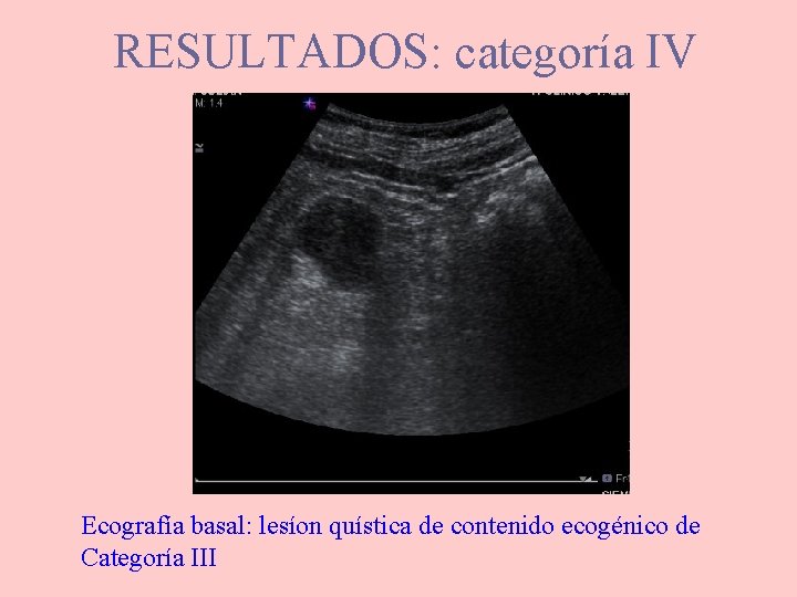 RESULTADOS: categoría IV Ecografía basal: lesíon quística de contenido ecogénico de Categoría III 