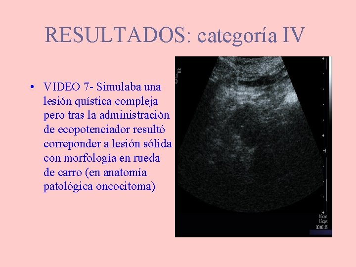 RESULTADOS: categoría IV • VIDEO 7 - Simulaba una lesión quística compleja pero tras