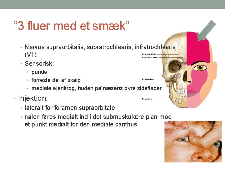 ” 3 fluer med et smæk” • Nervus supraorbitalis, supratrochlearis, infratrochlearis (V 1) •