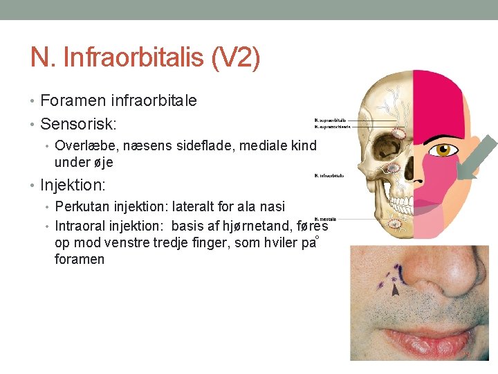 N. Infraorbitalis (V 2) • Foramen infraorbitale • Sensorisk: • Overlæbe, næsens sideflade, mediale