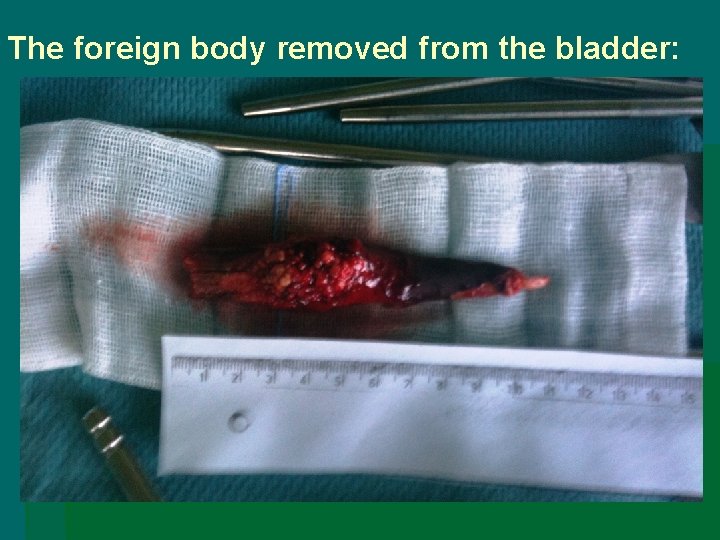 The foreign body removed from the bladder: 