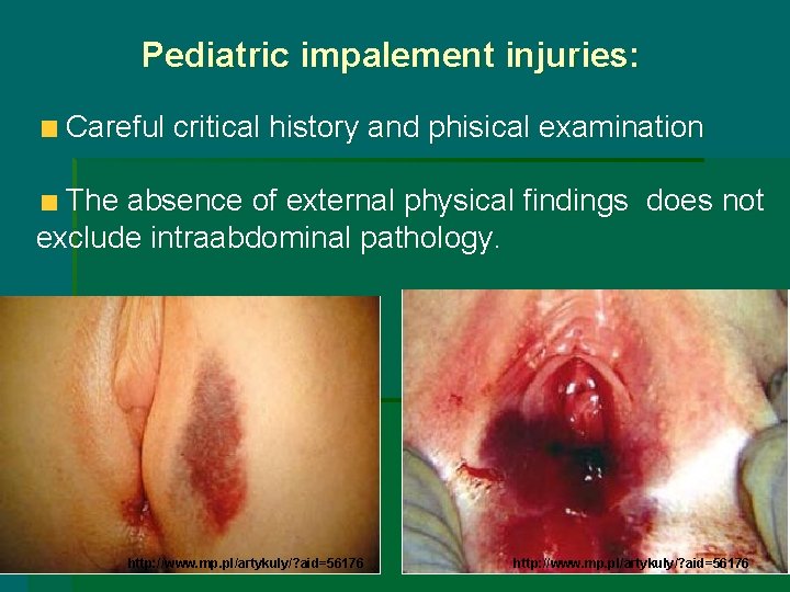 Pediatric impalement injuries: Careful critical history and phisical examination The absence of external physical