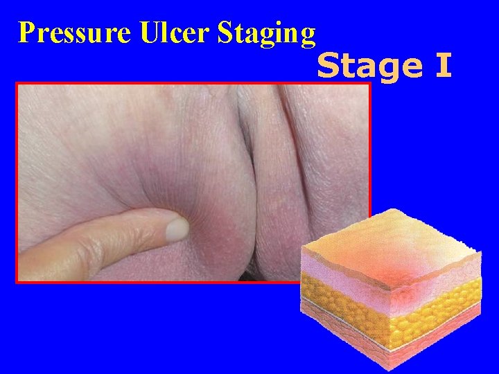Pressure Ulcer Staging Stage I 